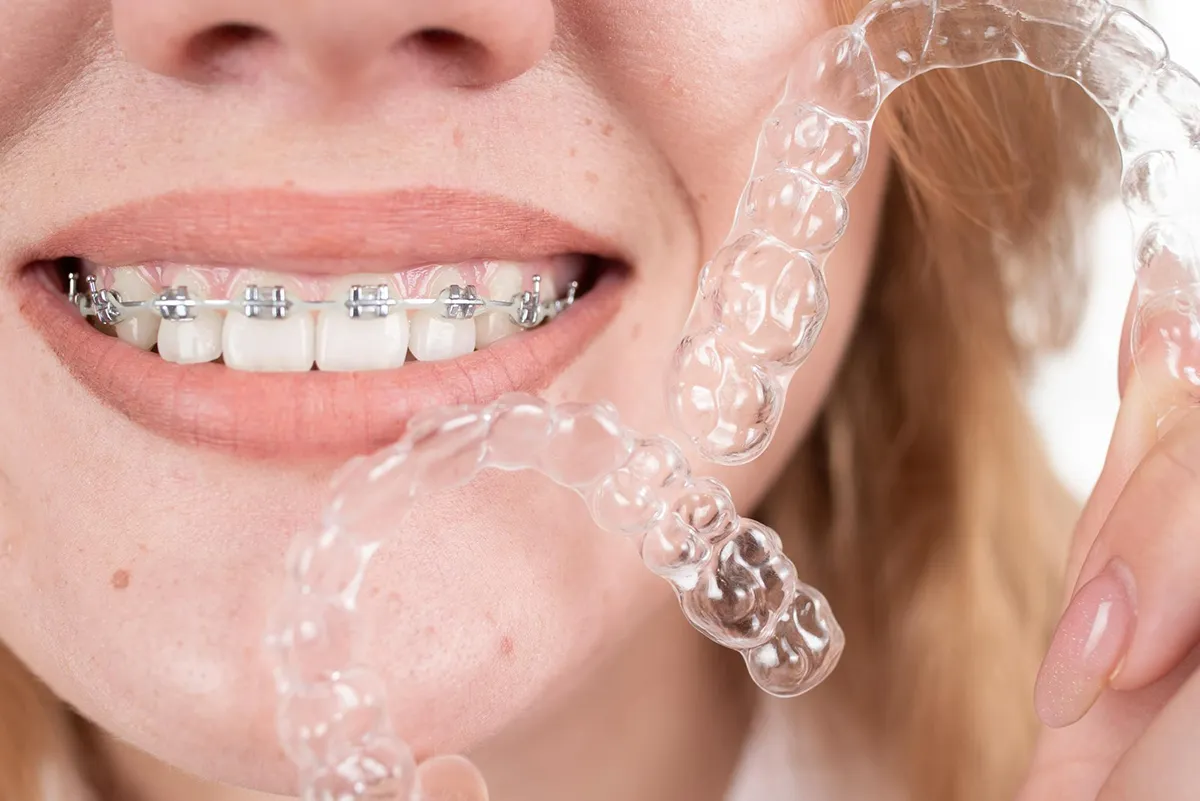 Caring for Your Braces or Aligners: Tips for Good Oral Hygiene   