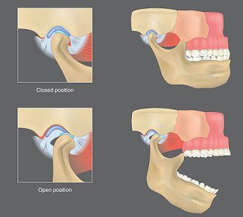 TMJ Disorders