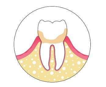 dental plaque