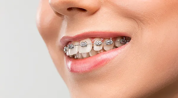What are benefits of adult orthodontics 