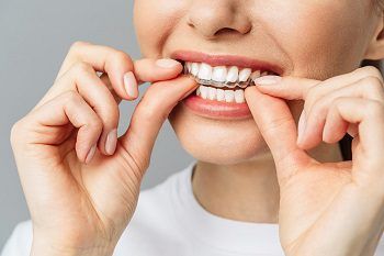 Invisalign