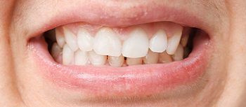 Teeth misalignment