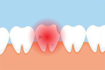 wisdom tooth infection