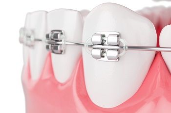 types of Orthodontic