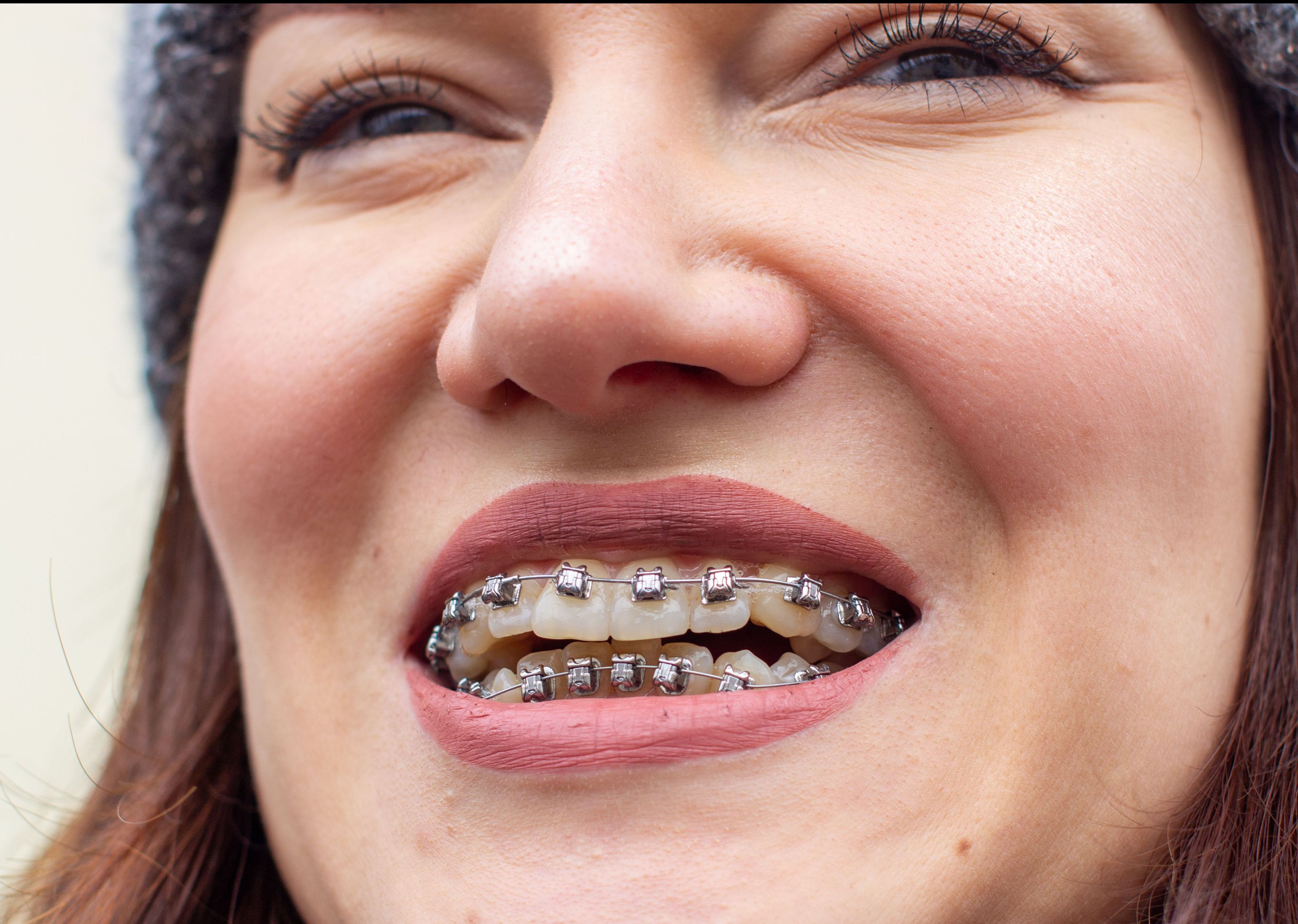 What Types of Braces Work Best for An Overbite?