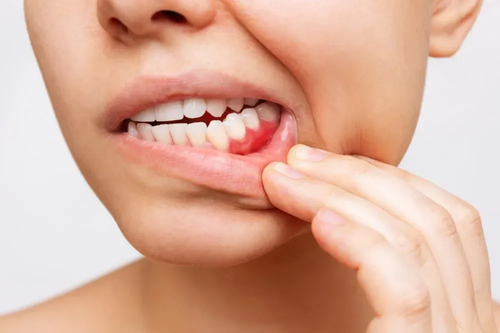 gum-inflammation-cropped-shot-young-woman-showing-red-bleeding-gums.webp