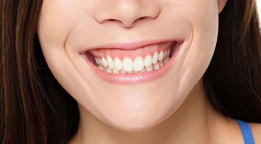 gum-lift-contouring-gummy-smile-woman-2-850x468.jpg