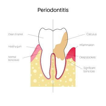 periodontitis